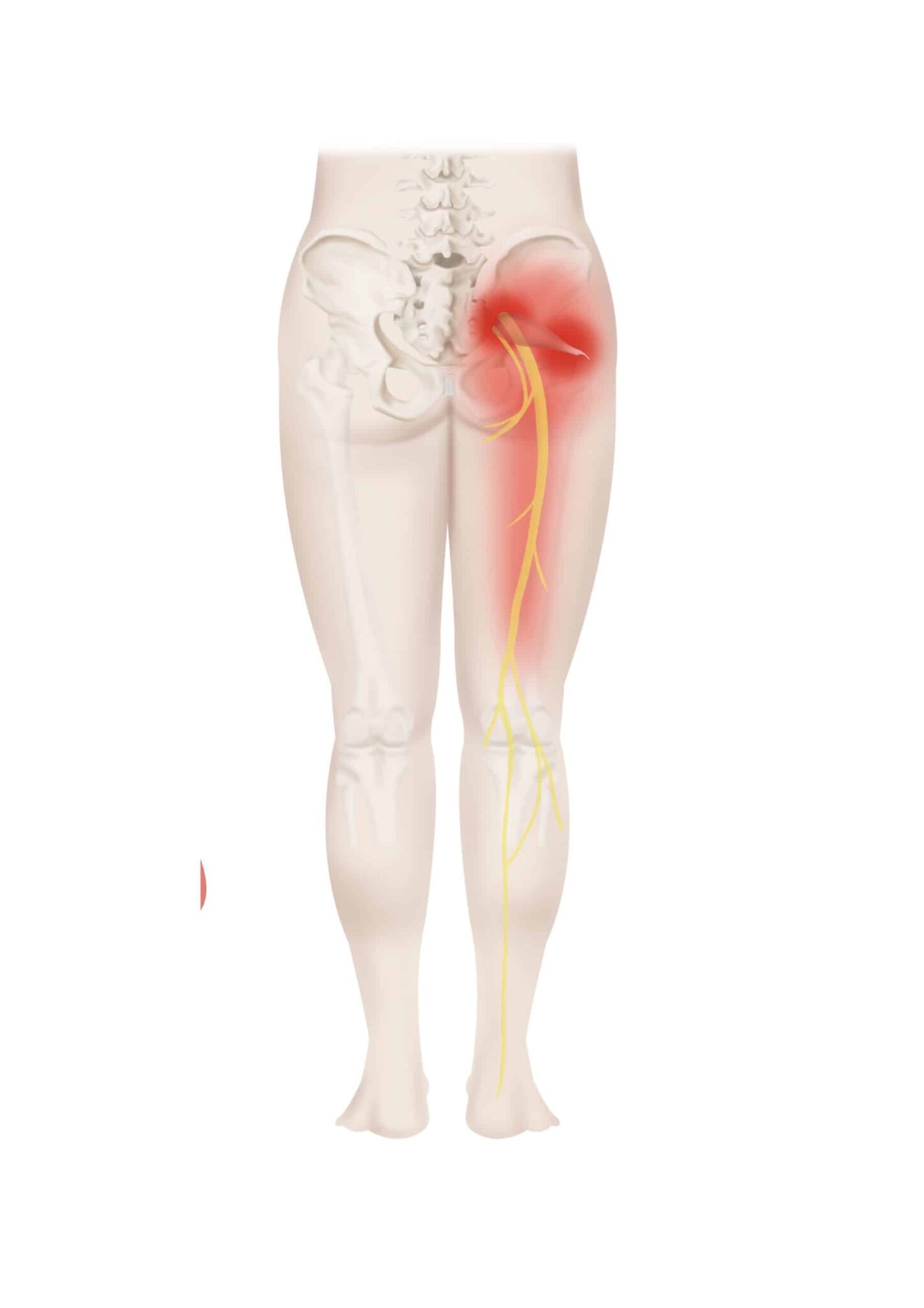 Anatomische afbeelding van het Piriformis syndroom- pijn in de heup - RunX